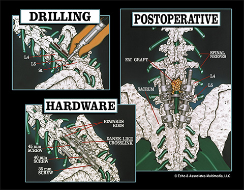Spinal Surgery Diagram